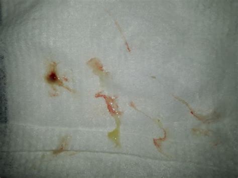 fotos de catarro com sangue-4
